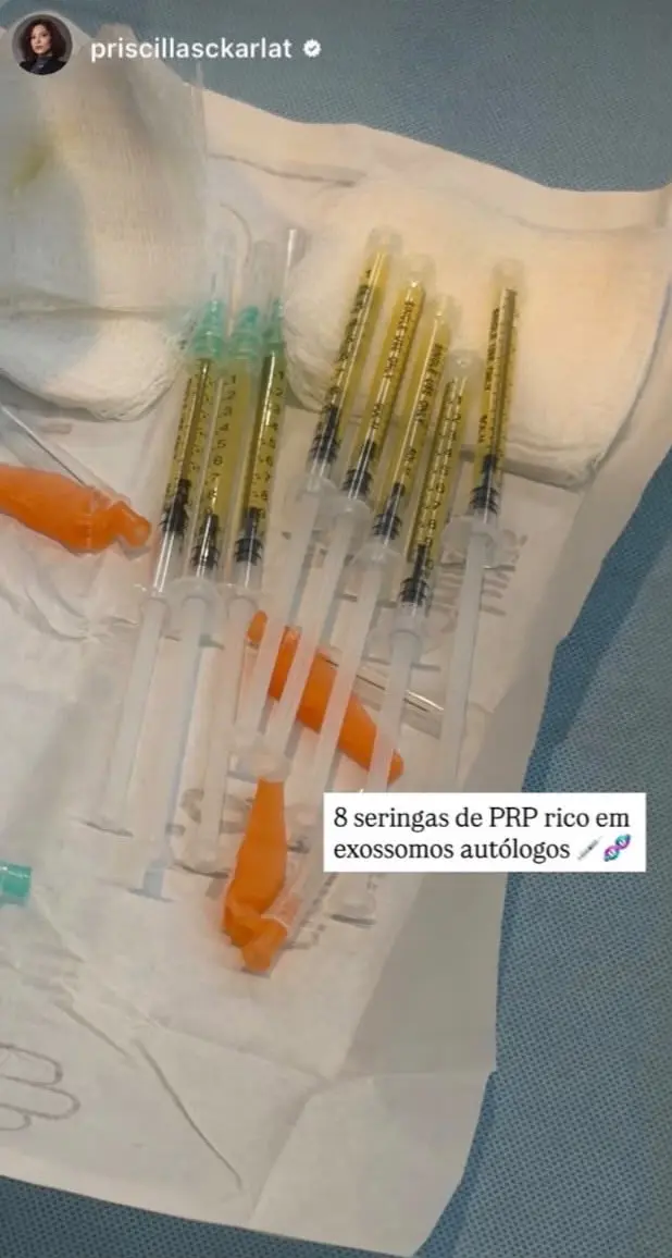 Seringas preparadas com plasma rico em exossomos autólogos
